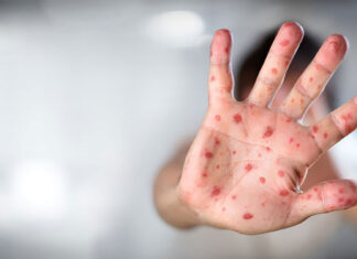 Rujeola, o boală fatală pentru 1/1000 de români